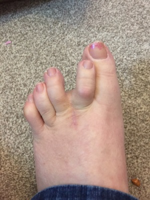 Morton's Neuroma scar one year one